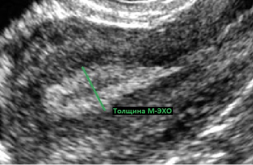 Серозометра после 60. Субинволюция матки УЗИ. М Эхо на УЗИ.