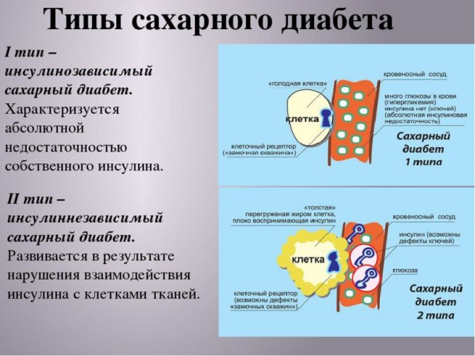 tipy-saharnogo-diabeta.jpg