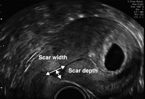Рубец на матке узи 16