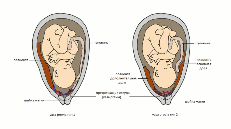 Зев закрыт при беременности. Центральное прикрепление хориона. Краевое прикрепление плода к плаценте. Прикрепление пуповины к плаценте центральное что значит. Край плаценты у внутреннего зева.