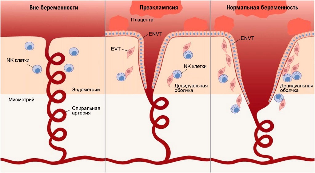 EVT - вневорсинчатый цитотрофобласт; NK - естественные клетки-киллеры.