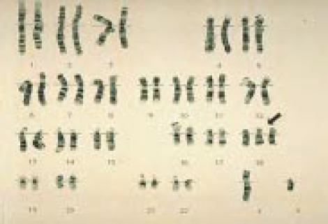 Хромосомы в случае синдрома Эдвардса - Трисомия 18