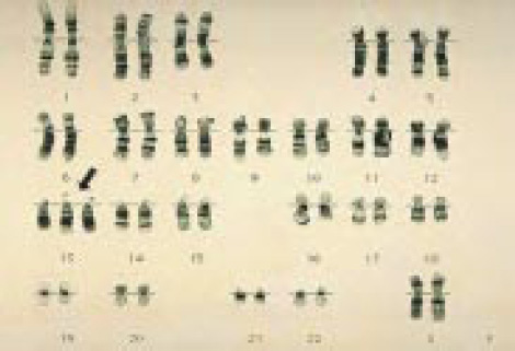 Хромосомы в случае синдрома Патау