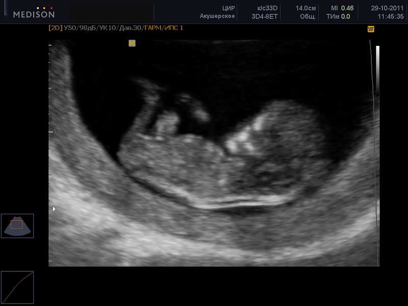 Физиологическая грыжа у эмбриона thumbnail